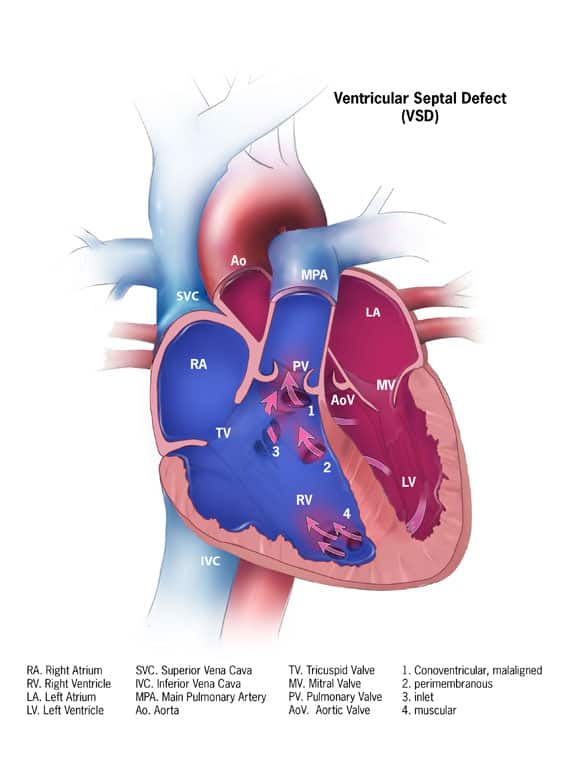 How does VSD (Ventricular Septal Defect) occur?