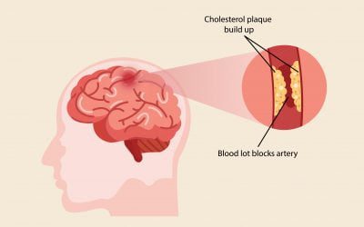 Atherosclerosis