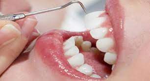 કોરોના અને દાંતની સારવાર