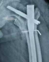 HIP Fracture-થાપાના ફેકચર વિશે અચૂક જાણવા જેવું