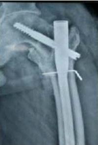 HIP Fracture-થાપાના ફેકચર વિશે અચૂક જાણવા જેવું