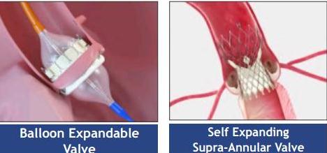 વગર ઓપરેશન વાલ્વ બદલવાની પ્રક્રિયા – ટાવી (TAVI)