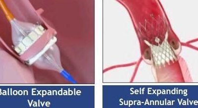 વગર ઓપરેશન વાલ્વ બદલવાની પ્રક્રિયા – ટાવી-(TAVI)
