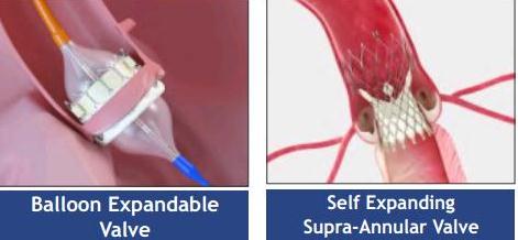 વગર ઓપરેશન વાલ્વ બદલવાની પ્રક્રિયા – ટાવી-(TAVI)