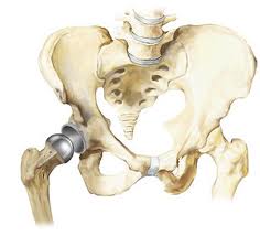 Hip Replacement