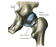 hip Replacement