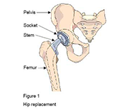 hip Replacement