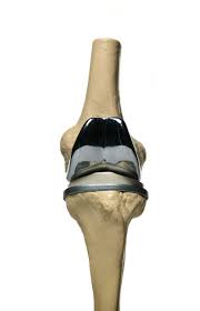 Knee Replacement