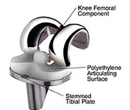 Knee Replacement