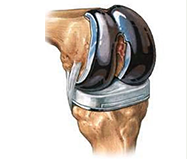 Knee Replacement