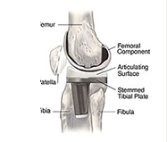 Knee Replacement