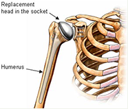 Shoulder Replacement